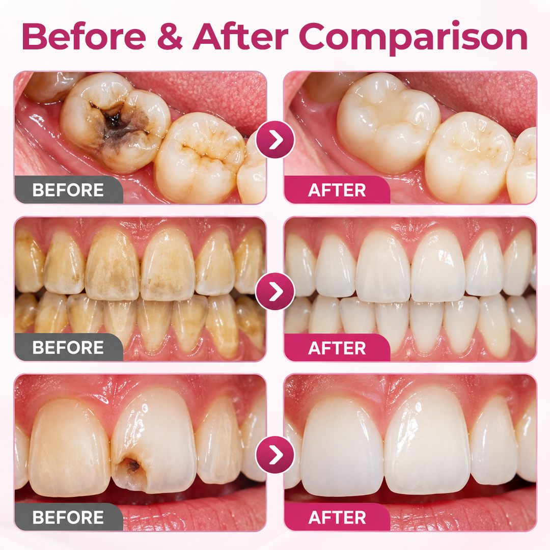 DenPerm Cavity-Repair Natural Enamel Filling Gel
