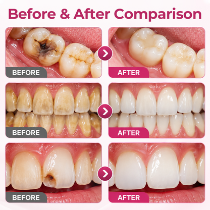 DenPerm Cavity-Repair Natural Enamel Filling Gel