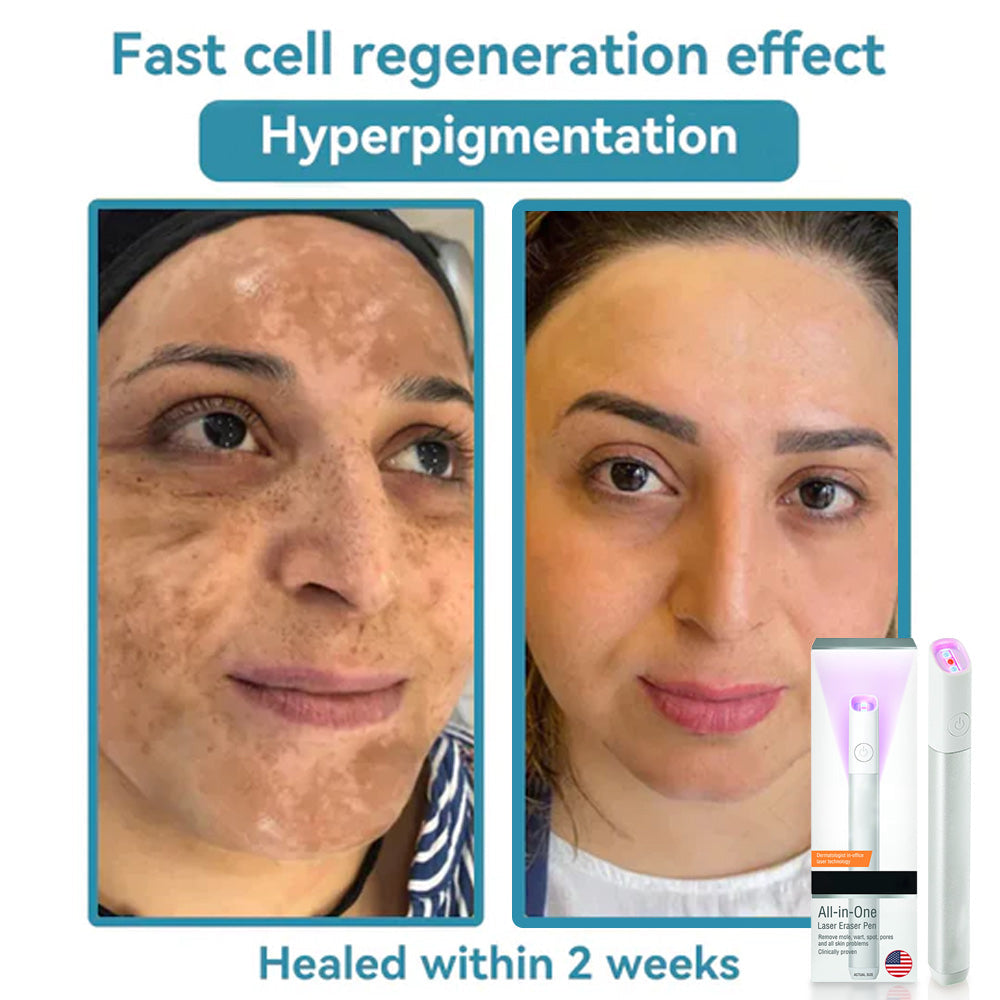 ✨All-in-One CO₂ Laser Eraser Pen | Removes Moles, Warts, Skin Flaws & Pigmentation