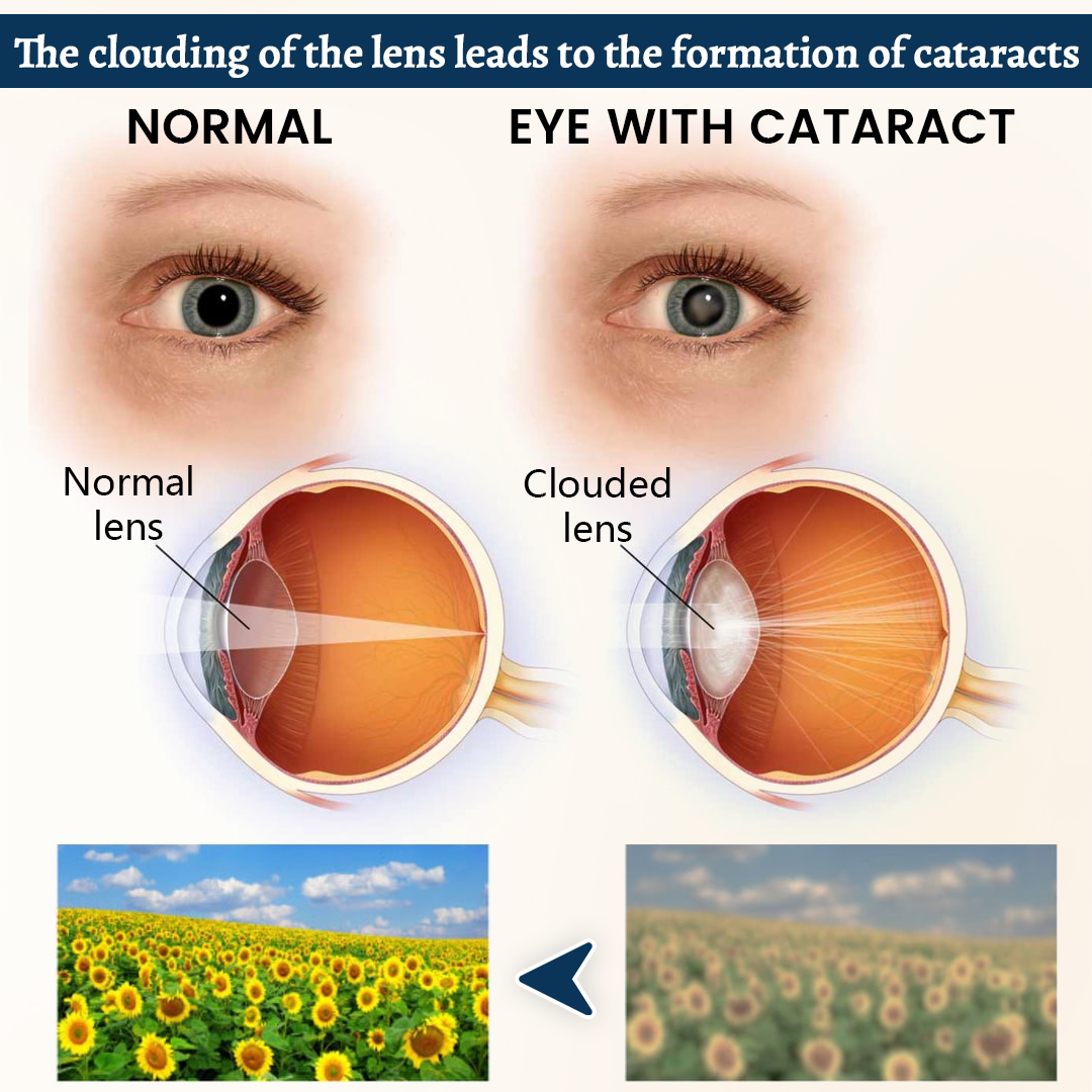 Ceoerty® OptiFusion Vision Support Eye Patch👁️✨