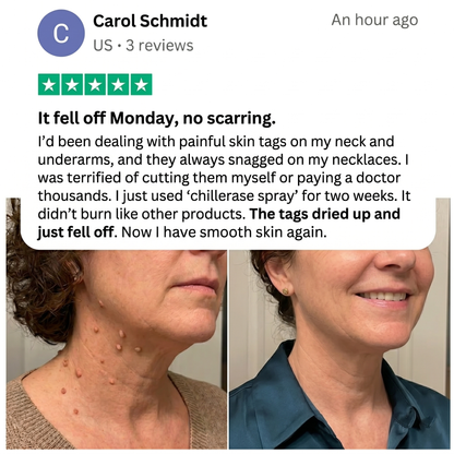 ChillErase Precision Skin Tag & Wart Removal Spray